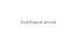 Esophageal atresia. Most frequent congenital anomaly of the esophagus, affecting 1 /4,000 neonates an abnormality in which the middle portion of the esophagus