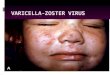 Varicella-zoster virus  Varicella-zoster virus (VZV) causes primary, latent, and recurrentinfections.  The primary infection is manifested as varicella