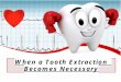 When a Tooth Extraction Becomes Necessary