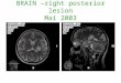 BRAIN –right posterior lesion Mai 2003