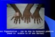 Excess Pigmentation – can be due to hormonal problem  (Hand in  middle is of one Doctor)