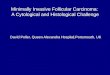 Minimally Invasive Follicular Carcinoma:  A Cytological and Histological Challenge