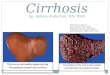 Cirrhosis by: Ashley Anderton, RN, BSN