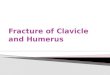 Fracture of Clavicle and  Humerus
