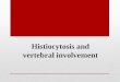 Histiocytosis  and vertebral involvement