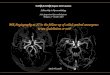 MR Angiography at 3T in the follow-up of coiled cerebral aneurysms:  to use Gadolinium or not?