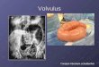 Volvulus Yonatan Abraham schuldenfrei. Volvulus Obstruction caused by twisting of the intestines more than 180 degrees about the axis of the mesentery