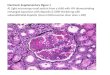 Electronic Supplementary Figure 1 A) Light microscopy renal section from a child with HIV demonstrating mesangial expansion with deposits & GBM thickening