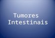 Tumores Intestinais. Intestino delgado 3 a 6% dos tumores do TGI Adenomas Leiomiomas,linfomas, neuromas Pólipos não neoplásicos Adenocarcinomas Sarcoma