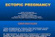 Ectopic Pregnancy3