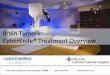 Brain Tumors: Illinois CyberKnife Treatment Overview