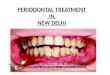 best periodontal treatment in delhi