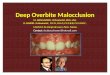 Deep bite malocclusions-M. ABOULNASER- Orthodontist, BUA, USA. O. SANDID- Orthodontist