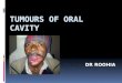 Tumours of oral cavity