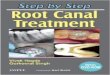 Step by step root canal treatment
