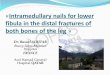 «Intramedullary nails for lower fibula in the distal fractures of both 
