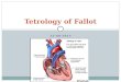 Tetrology of Fallot (TOF) - A Review