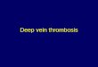 2 deep vein thrombosis