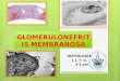 Glomerulonefritis membranosa membranous glomerulonephritis Nefropatia Membranosa