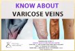 Know about varicose veins | Best Treatment for Varicose Veins