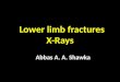 fractures of the lower limb
