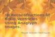 3D Reconstructions of Brain Ventricles Using Anaglyph Images
