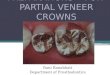 Tooth preparation for partial veneer crwns