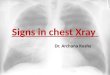 Signs in Chest Xray
