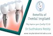 Benefits Of Dental Implants | | Dental Impalnts in Bangalore