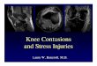 Knee Contusions and Stress Injuries - ContinuPrint, · PDF filePivot Shift • Knee valgus, femur internally rotated • Deceleration-rotational-valgus stress • ACL rupture • Impaction