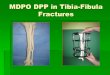 MDPO DPP in Tibia-Fibula Fractures Fracture.pdf · Lower Shaft Tibia-Fibula Fracture Frame Construct -Proximal block composed of two proximal closed circular rings (above fracture)