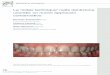 La “index technique” nella dentizione usurata: un nuovo ... · PDF filecambiamenti di abitudini, una dieta non ... rina viene creata iniettando del materiale sopra al modello con