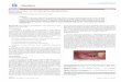 Retrospective on Treating Periimplantitis on Treating Periimplantitis ... has progressed from treatment with chemical means to use of laser ... (patient refused root canal treatment),