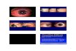 Concretions (Lithiasis) - IU Optometry melanocytosis: only the eye is ... Amelanotic tumors are salmon or ... Conjunctival2006.ppt Author: tgreene Created Date: