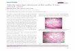 Our Dermatology Online Clinical Image Tubular apocrine ... · Tubular apocrine adenoma of the axilla: A rare adnexal tumor Salsabil Attafi, Ines Smichi, Wafa Rkik ... tubular structures