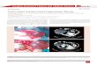 Giant renal Cyst into Giant Laparotomic Hernia Journal of Clinical and Medical Sciences Citation: Pérez Lara FJ, Alcaraz DH, Carmona JH, del Rey Moreno A, Muñoz HO (2014) Giant renal