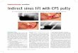 dentalxp.comdentalxp.com/content/1395/55b3cd8d-6ea9-4099-9736-16d35758c6e4.pdfIndirect sinus lift with CPS putty ... (crestal approach) or the indirect sinus lift procedure. ... again