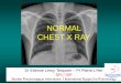 NORMAL CHEST X RAY - ISR Radiology NormalCXR.pdf · cleido-mastoid muscle . Thoracic wall The clavicles are projected on the level of the 3rd or 4th ... Normal chest x-ray , front