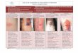 Skin Tear assessment and management guidelines - CH2direct.ch2.net.au/direct_static/product_documents/promo-229-Skin... · SKIN TEAR ASSESSMENT & MANAGEMENT GUIDELINES ‘STAR’