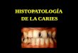 HISTOPATOLOGÍA DE LA CARIES - personal.us.es PTDI... · HISTOPATOLOGÍA DE LA CARIES - Caries de dentina - La caries del esmalte puede llegar a alcanzar la dentina sin que se haya