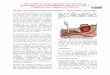 Tecnica de traqueotomia percutanea No disponibilidad de broncoscopio flexi-ble y rígido y / o ultrasonidos: localizar y entrar en la tráquea con una aguja guía puede ser difícil
