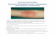 Eczema Dermatitis Eczema Dermatitis Causes ... - … Dermatitis Causes... · Eczema Dermatitis 1 Eczema Dermatitis Causes, Symptoms, and Natural Treatments Eczema is a condition where