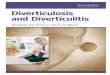 Diverticulosis and Diverticulitis - Home | Blue Cross and ... · Diverticulosis and Diverticulitis Managing Two Common Colon Conditions. ... Pour yourself a cup every hour or so