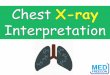 Normal Chest X-ray - medfreecon.files.wordpress.com · Hydropneumothorax •Air in pleural 