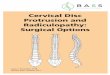 Cervical Disc Protrusion and Radiculopathy: Surgical Options · Cervical discectomy (removal of disc) and artificial disc replacement can be performed when there is a disc protrusion