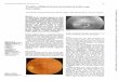 Fundus albipunctatus associatedwith dystrophyShiroyama,Sugita,Horiguchi, Yagasaki Figure5 Fundus photograph(A)and fluorescein angiography(B) oftheleft eyein case4. FigSB FigSA 192