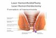 Laser HemorrhoidoPlasty Laser Hemorrhoidectomy · Hemorrhoid Laser Procedure. Facts on Hemorrhoidoplasty: Couple of days until a week in hospital Pain for 7-10 days Postoperative