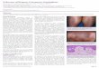 A Review of Primary Cutaneous Amyloidosis...Primary cutaneous amyloidosis is characterized by amyloid deposition in the skin without systemic involvement. This article reviews the