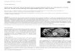 Retroperitoneal leiomyosarcoma associated with an elevated b-HCG serum level mimicking extragonadal germ cell tumordownloads.hindawi.com/journals/srcm/2000/501959.pdf · Sarcoma(2000)4,179±181