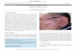 Left swollen ear - idoriums.com Journal of Case Reports and...included erysipelas, perichondritis, contact dermatitis, and the early stage of herpes zoster. Bacterial culture of skin